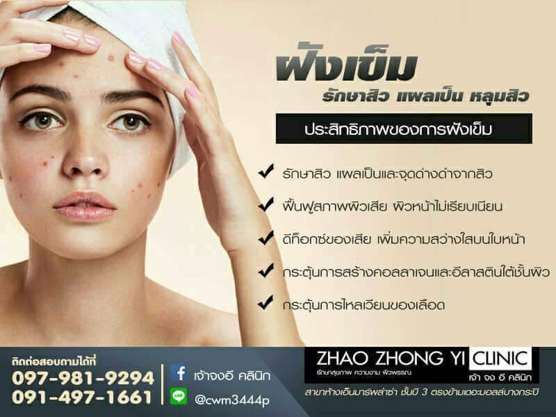 ฝังเข็ม รักษาสิว แผลเป็น หลุมสิว Acupuncture  acne scar