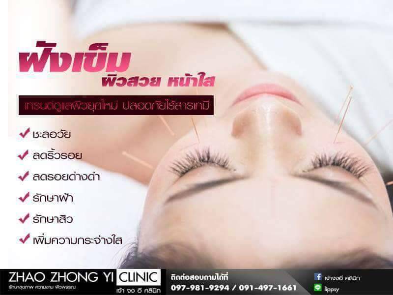 ฝังเข็ม รักษาสิว แผลเป็น หลุมสิว Acupuncture  acne scar